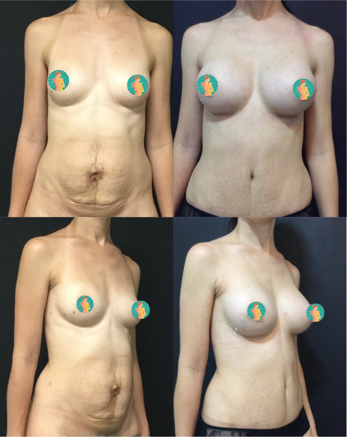 Abdominoplastia