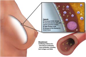 Silicone causa câncer