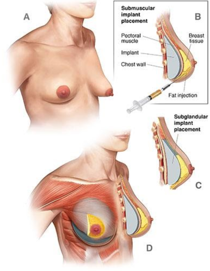 Mamoplastia Aumento